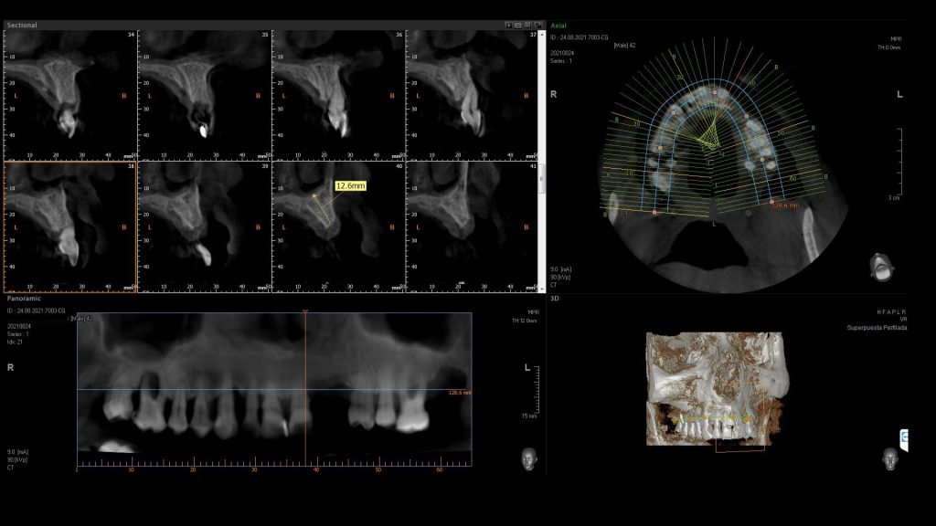 que es la cirugía guiada de implantes