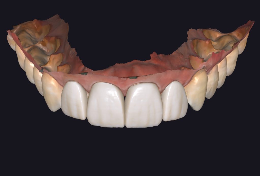 ¿qué es el diseño de sonrisa?