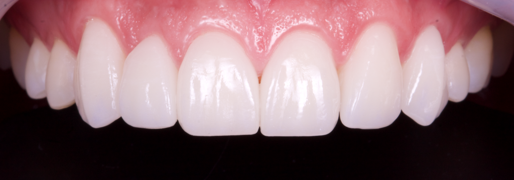 blanqueamiento dental